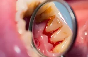 How to Prevent Bleeding Gums: Simple Daily Habits for Healthier Gums