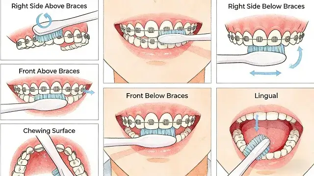 How to Brush Your Teeth Correctly