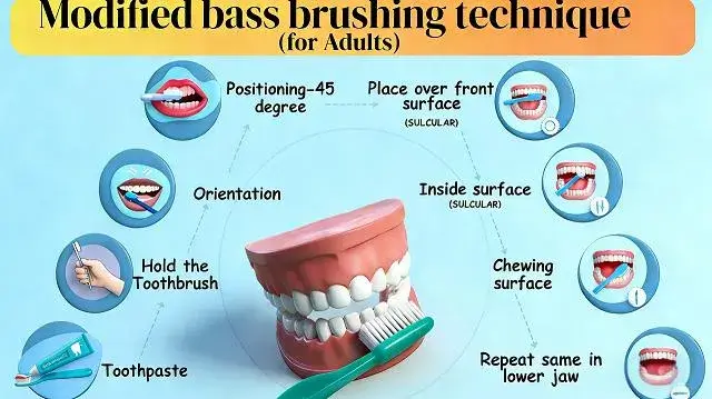 What Causes Cavities (Tooth Decay)?
