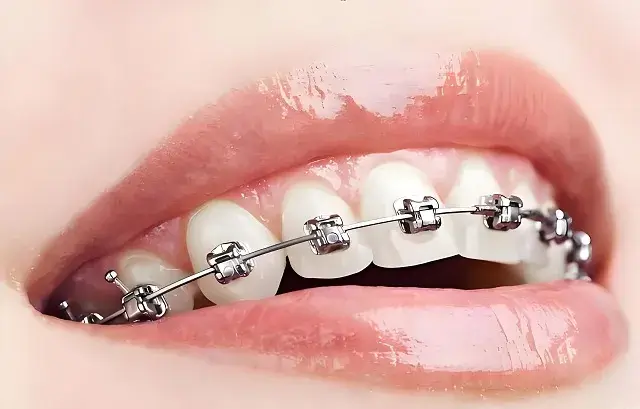 Orthodontic Treatment