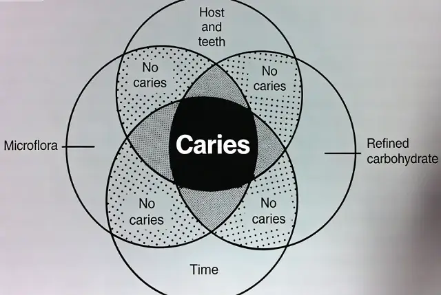 What Causes Cavities (Tooth Decay)?
